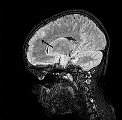 Case report: A case of acute disseminated encephalomyelitis after SARS-CoV-2 infection in pediatric patients